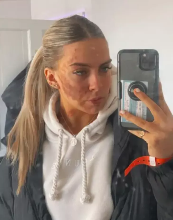sivilce tiktok