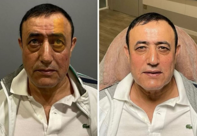 Mahmut Tuncer Estetik Yaptirdi Sosyal Medyada